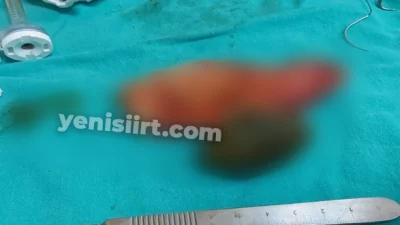 Siirt’te bir hastanın safra kesesinden ceviz büyüklüğünde taş çıkartıldı! Siirt'in Kurtlan ilçe devlet hastanesinde 43 yaşındaki bir kadın, safra
